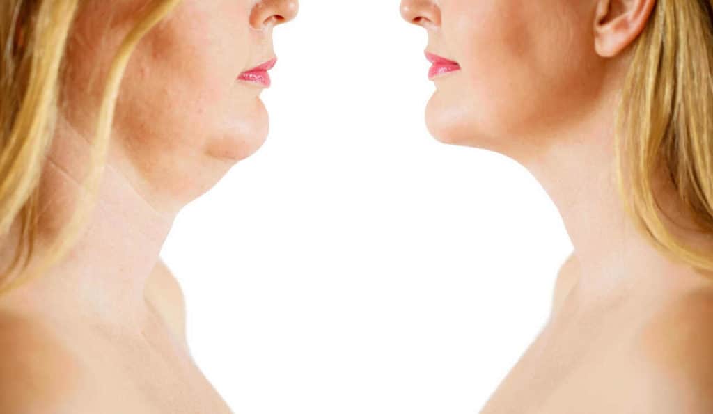 Double Chin treatment Leyton Marshes before and after results
