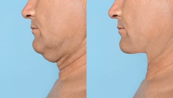 Which Non-Surgical Treatments Work Best for Jowls and Loose Skin Leyton Marshes?