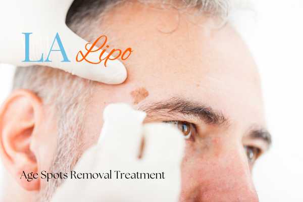 What Are the Most Effective Treatments for Age Spots Leyton Marshes?