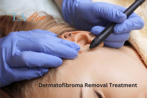 Dermatofibroma Removal Treatment Leyton Marshes