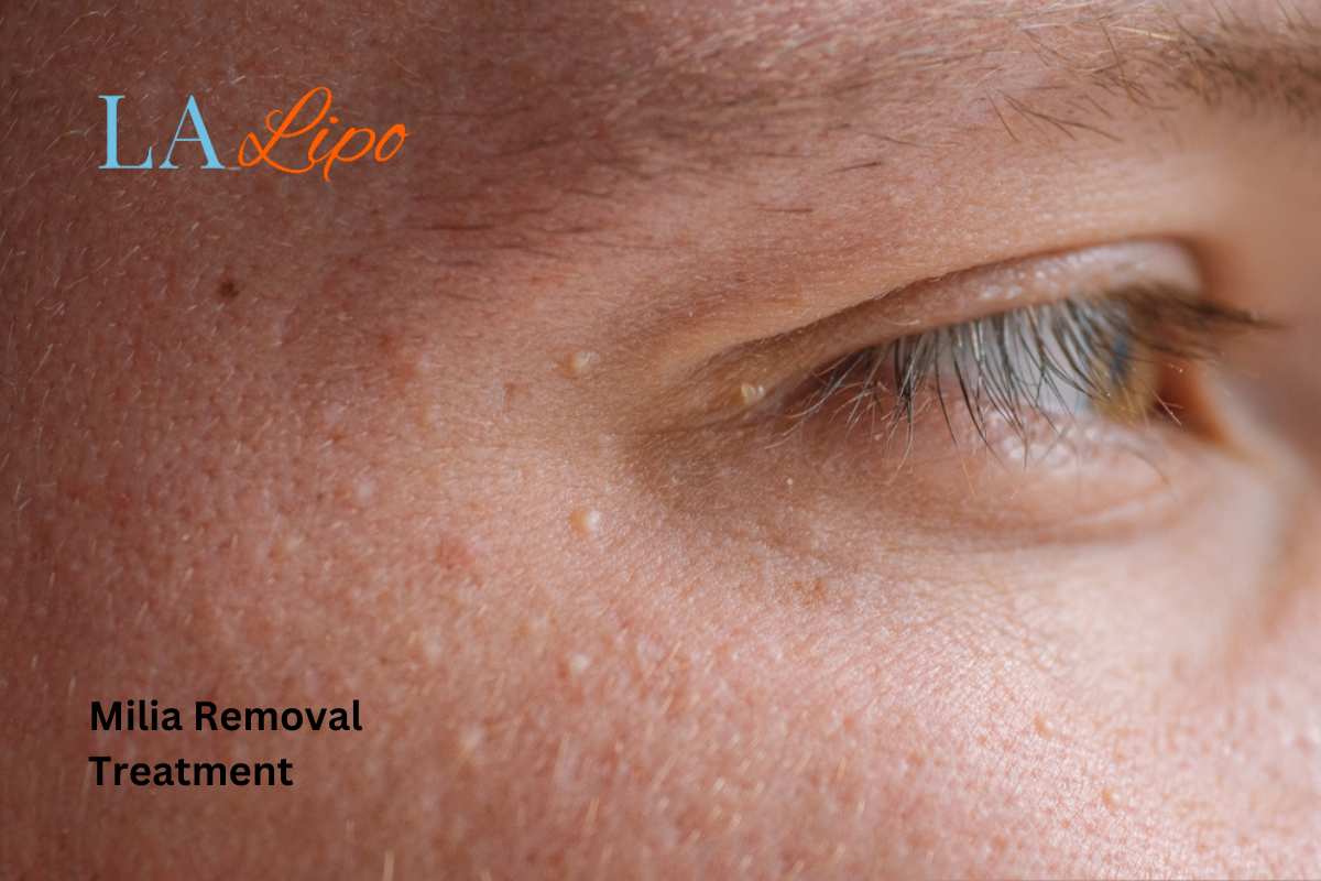 Cryopen Milia Removal: Is It the Easiest and Safest Option Leyton Marshes?