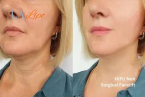 hi-fu for wrinkles Leyton Marshes before and after results