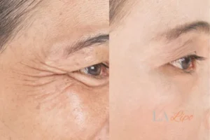 Before and after results of woman - HI-fu wrinkles reduction treatment Leyton Marshes