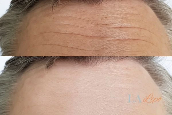 results of HIFU Leyton Marshes on mans forehead to help reduce lines and wrinkles
