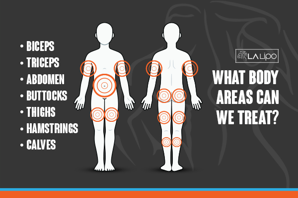 Graphic to show areas you can have LA-EMS Body Sculpting Leyton Marshes treatment.