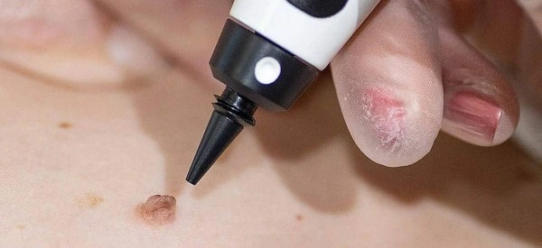 skin tag removal using cryopen Leyton Marshes