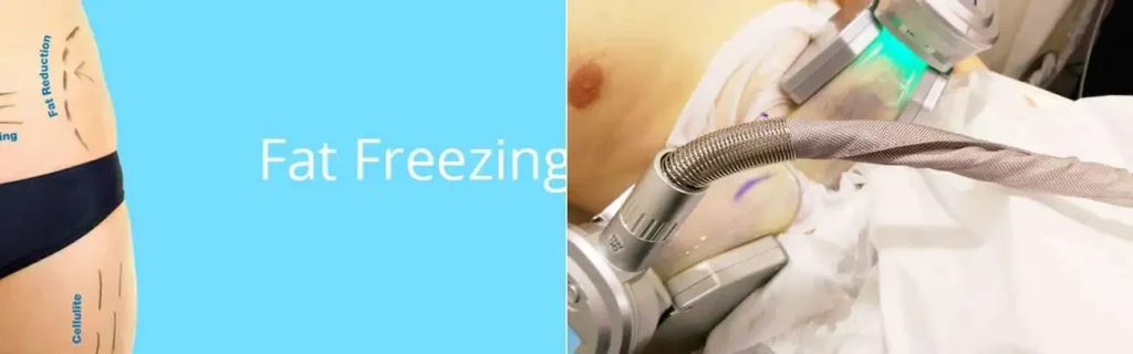 multi areas of a persons body having coolsculpting Leyton Marshes treatment