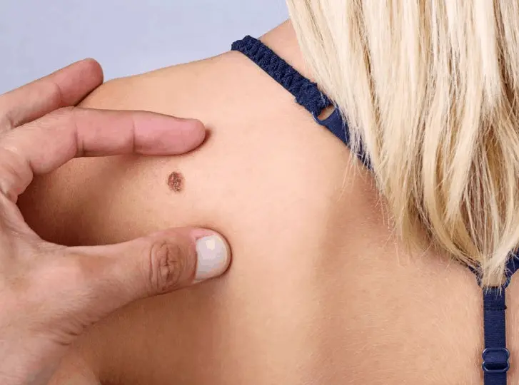woman having mole removal Leyton Marshes consultation before treatment.