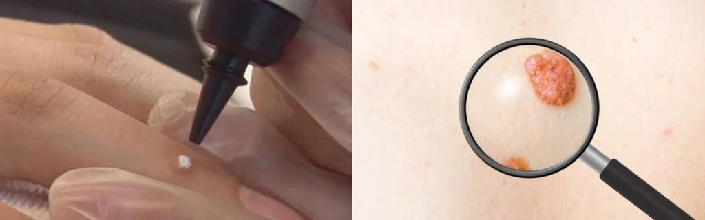 Person getting moles removed with cryopen Leyton Marshes