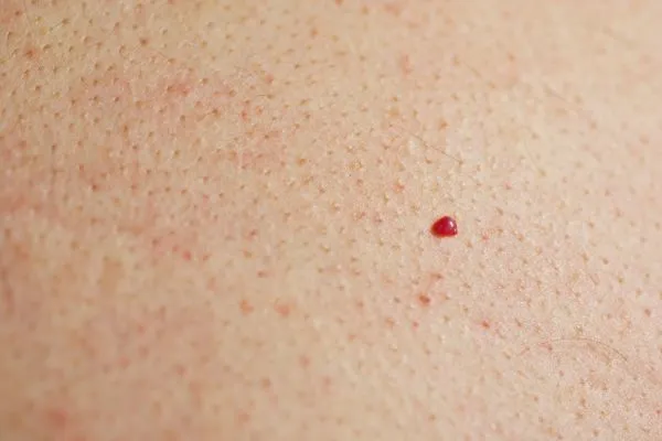 close up of a cherry angioma Leyton Marshes