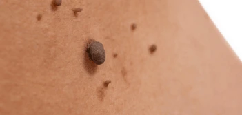 image of a skin tag Leyton Marshes