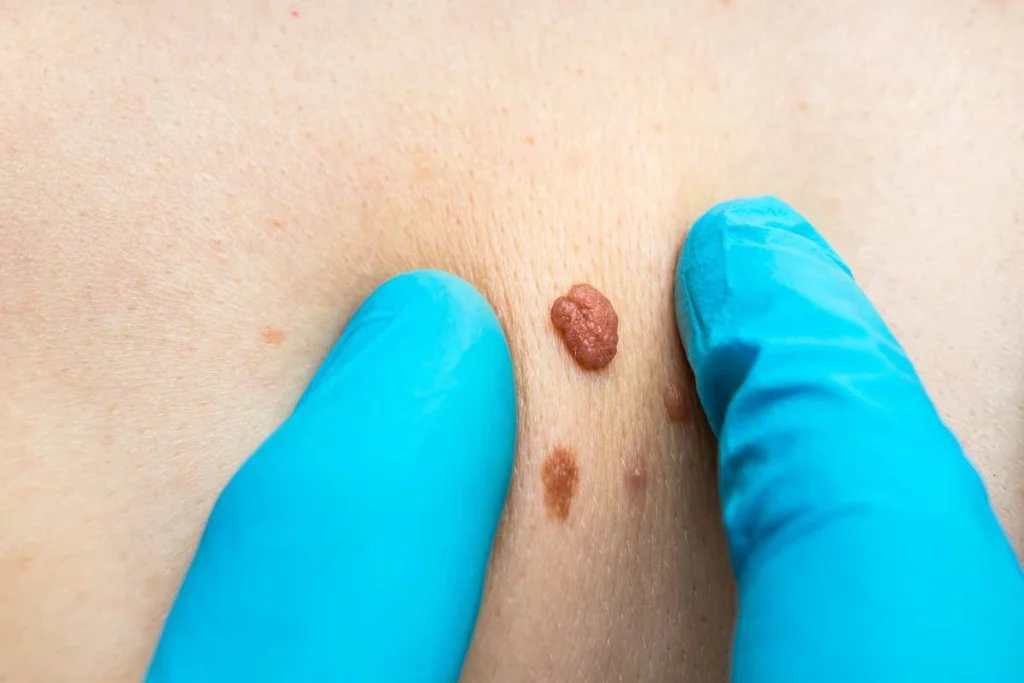 Consultant examining a skin tag Leyton Marshes