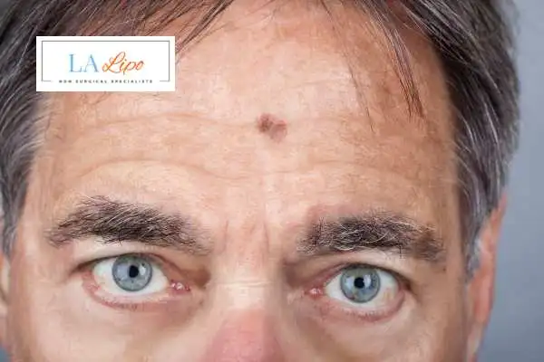 Solar Lentigo Removal Leyton Marshes image of man with mark on his forehead