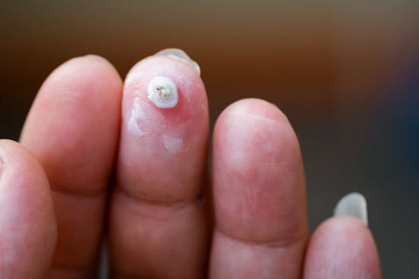 wart on person finger - cryotherapy to treat from LA LIPO Leyton Marshes