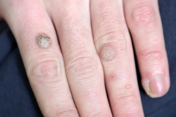 photo of warts on person hand - see wart removal Leyton Marshes from LA LIPO