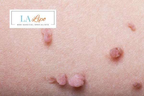 Does cryopen skin tag removal Leyton Marshes hurt? Find out now call our team today!