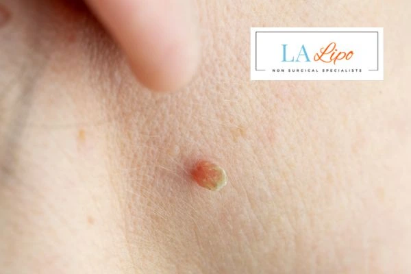 Book skin tag removal Leyton Marshes today speak to our team now!