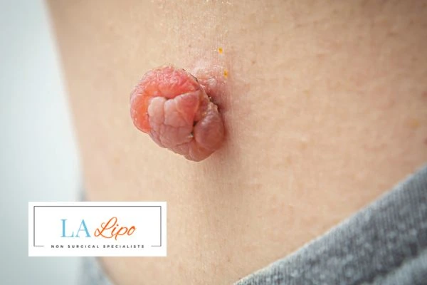 Interested in skin tag removal Leyton Marshes? Concerned about the pain? Find out more today!