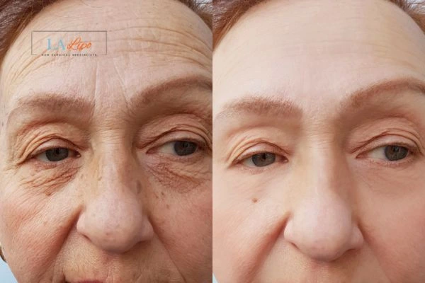 The powerful benefits of Morpheus8 Treatment Leyton Marshes - Call Our team today!