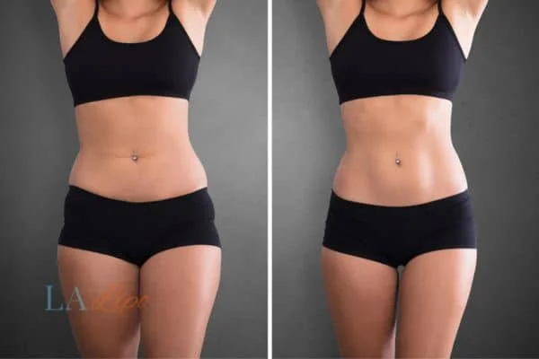 before and after results of non-surgical treatment to help a woman's body image and mental health Leyton Marshes