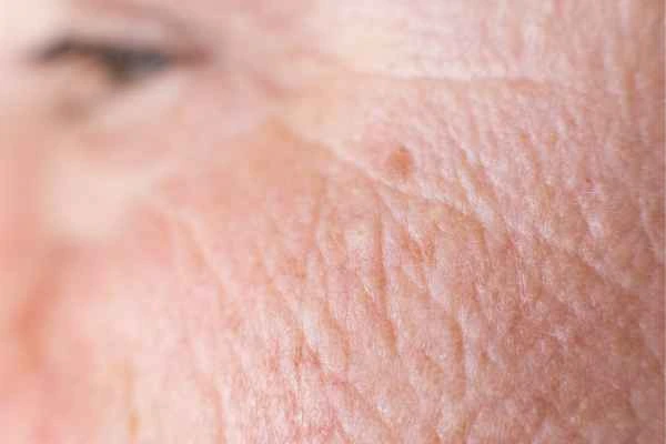 close up picture of a woman's face showing an age spot Leyton Marshes
