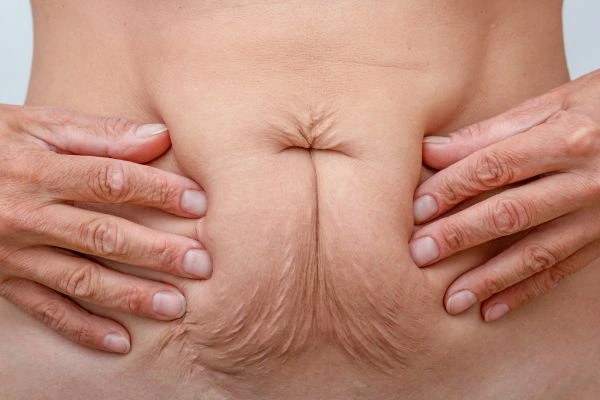 Image of a woman's stomach with loose skin - example of skin tightening Leyton Marshes options