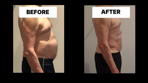 What Symptoms Can Diastasis Recti Cause in Men? Weak Core, Back Pain and Poor Posture Leyton Marshes